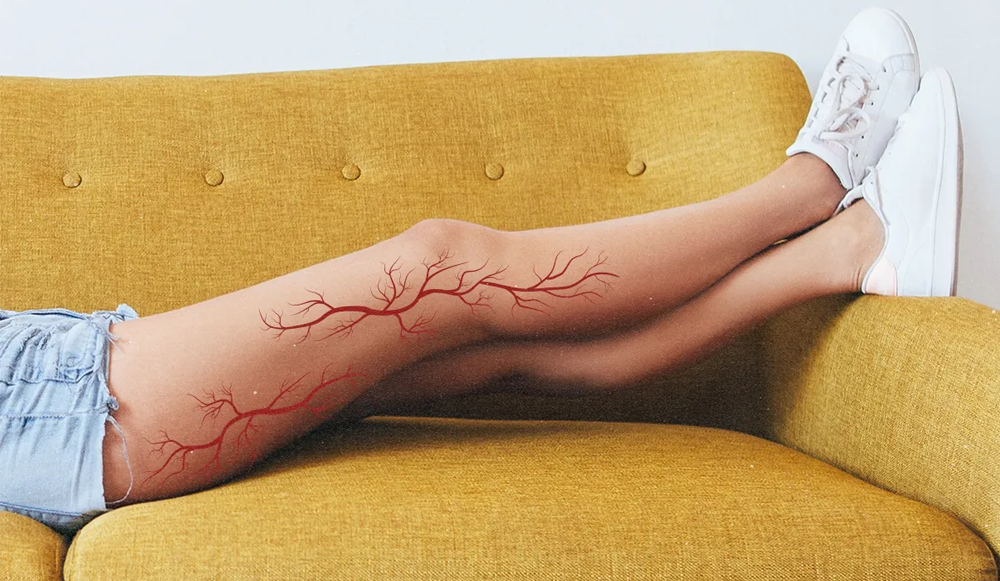 Tratando las varices naturalmente